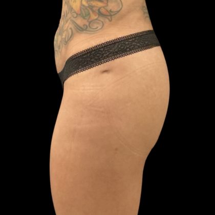 Alloclae Before & After Patient #11871