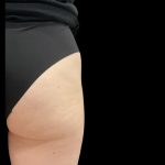 Alloclae Before & After Patient #11885
