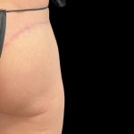 Alloclae Before & After Patient #11888