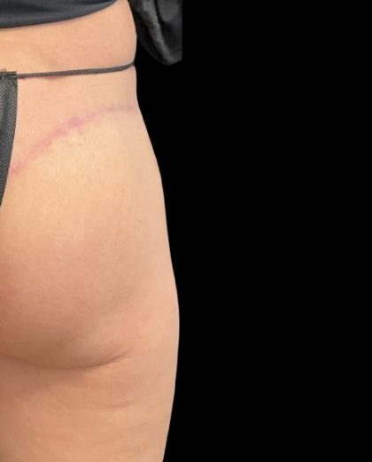Alloclae Before & After Patient #11888