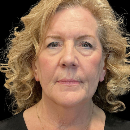 AVAVA Laser Before & After Patient #12238