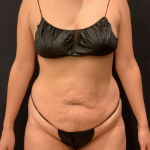 Miami Makeover Before & After Patient #12240