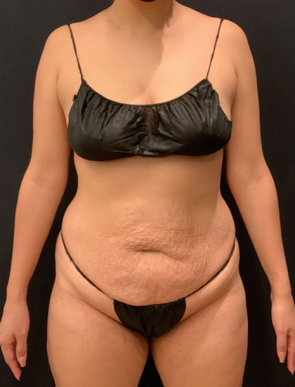 Miami Makeover Before & After Patient #12240