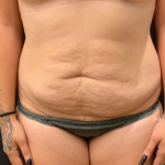 Miami Makeover Before & After Patient #12244