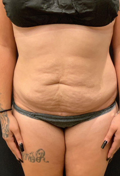 Miami Makeover Before & After Patient #12244
