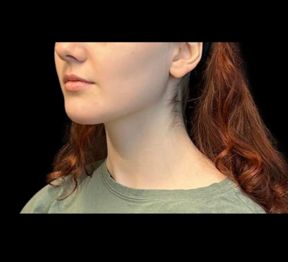 Chin Augmentation Before & After Patient #12230