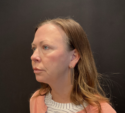 Blepharoplasty Before & After Patient #12228