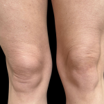 AVAVA Laser Before & After Patient #12236