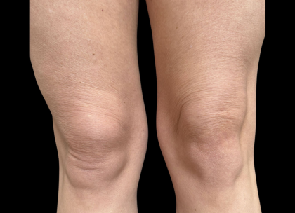 AVAVA Laser Before & After Patient #12236