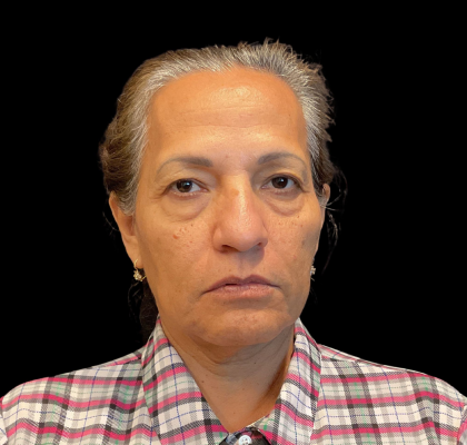 Blepharoplasty Before & After Patient #12227