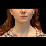 Chin Augmentation Before & After Patient #12230
