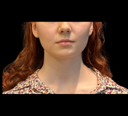 Chin Augmentation Before & After Patient #12230
