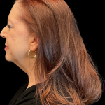 Facelift Before & After Patient #12052