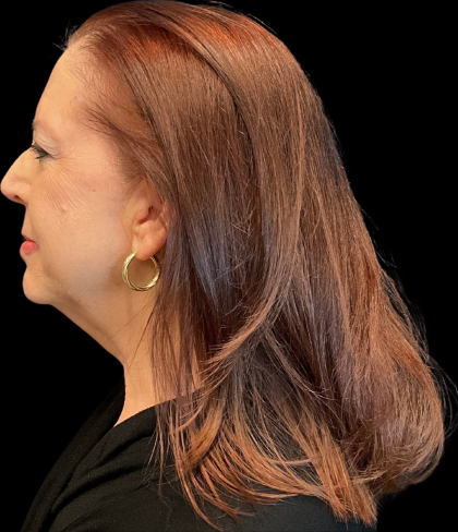 Facelift Before & After Patient #12052