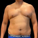 High Definition Liposuction Before & After Patient #12037