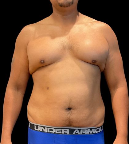 High Definition Liposuction Before & After Patient #12037