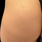 Alloclae Before & After Patient #12055
