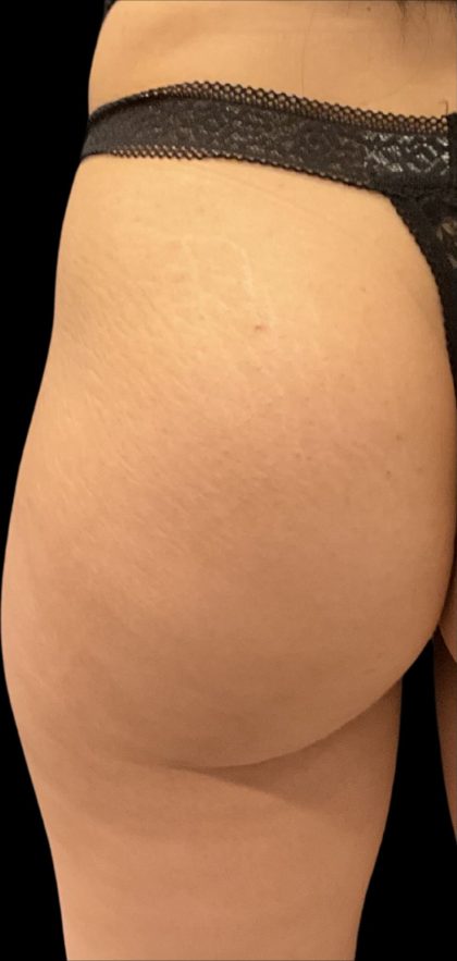 Alloclae Before & After Patient #12055