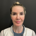 Instalift Before & After Patient #12234