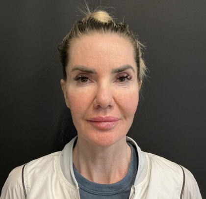 Instalift Before & After Patient #12234