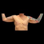 Brachioplasty Before & After Patient #12169