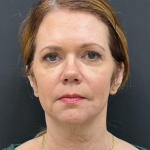 Brow Lift Before & After Patient #12047