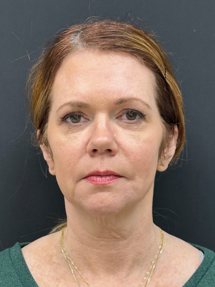 Brow Lift Before & After Patient #12047