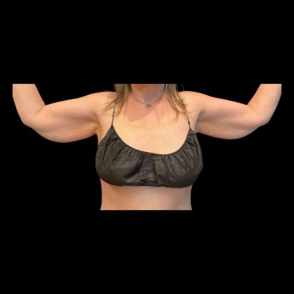 Brachioplasty Before & After Patient #12168