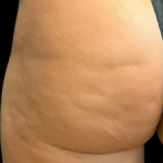 Alloclae Before & After Patient #12054