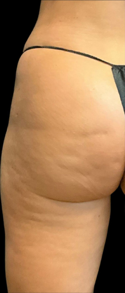Alloclae Before & After Patient #12054