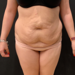 Miami Makeover Before & After Patient #12241