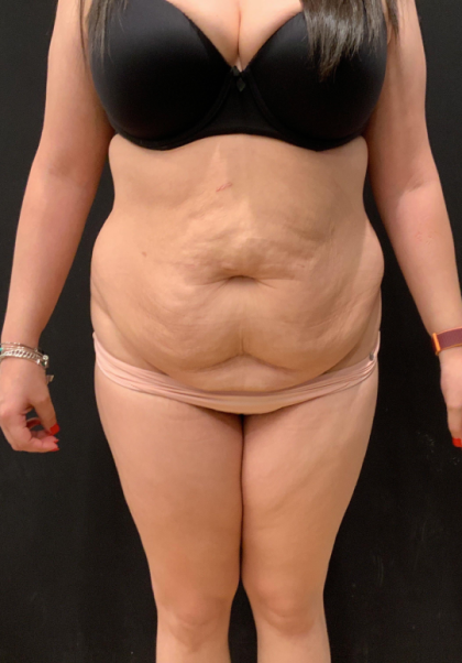 Miami Makeover Before & After Patient #12241
