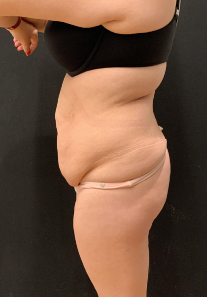 Miami Makeover Before & After Patient #12241