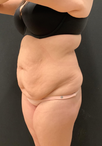 Miami Makeover Before & After Patient #12241