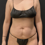Miami Makeover Before & After Patient #12242