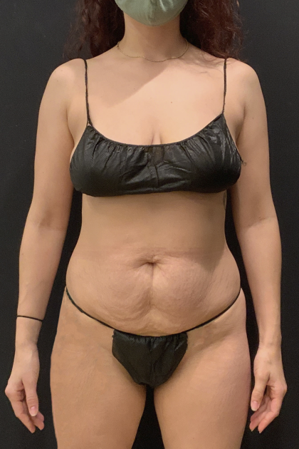 Miami Makeover Before & After Patient #12242