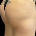 Alloclae Before & After Patient #12058