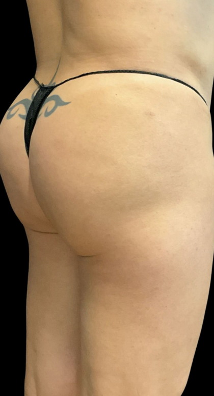 Alloclae Before & After Patient #12058
