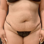 Miami Makeover Before & After Patient #12243