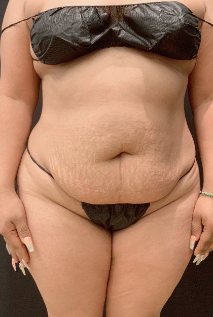 Miami Makeover Before & After Patient #12243
