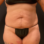 Tummy Tuck Before & After Patient #12246