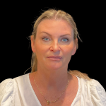 Blepharoplasty Before & After Patient #12229