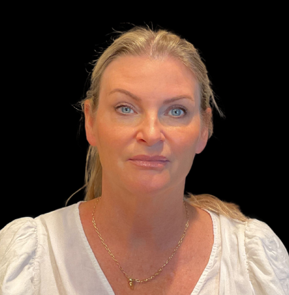 Blepharoplasty Before & After Patient #12229
