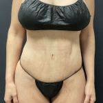 Tummy Tuck Before & After Patient #12457