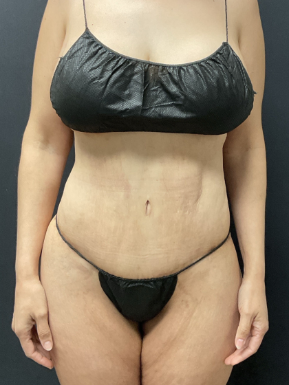 Tummy Tuck Before & After Patient #12457