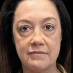 AVAVA Laser Before & After Patient #12237