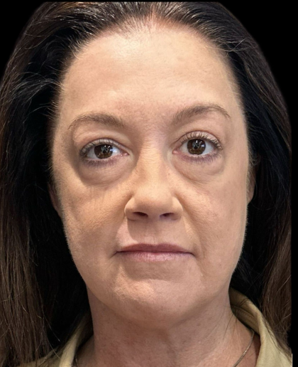 AVAVA Laser Before & After Patient #12237
