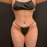 Miami Makeover Before & After Patient #12239