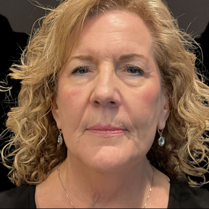 AVAVA Laser Before & After Patient #12238