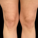 AVAVA Laser Before & After Patient #12236